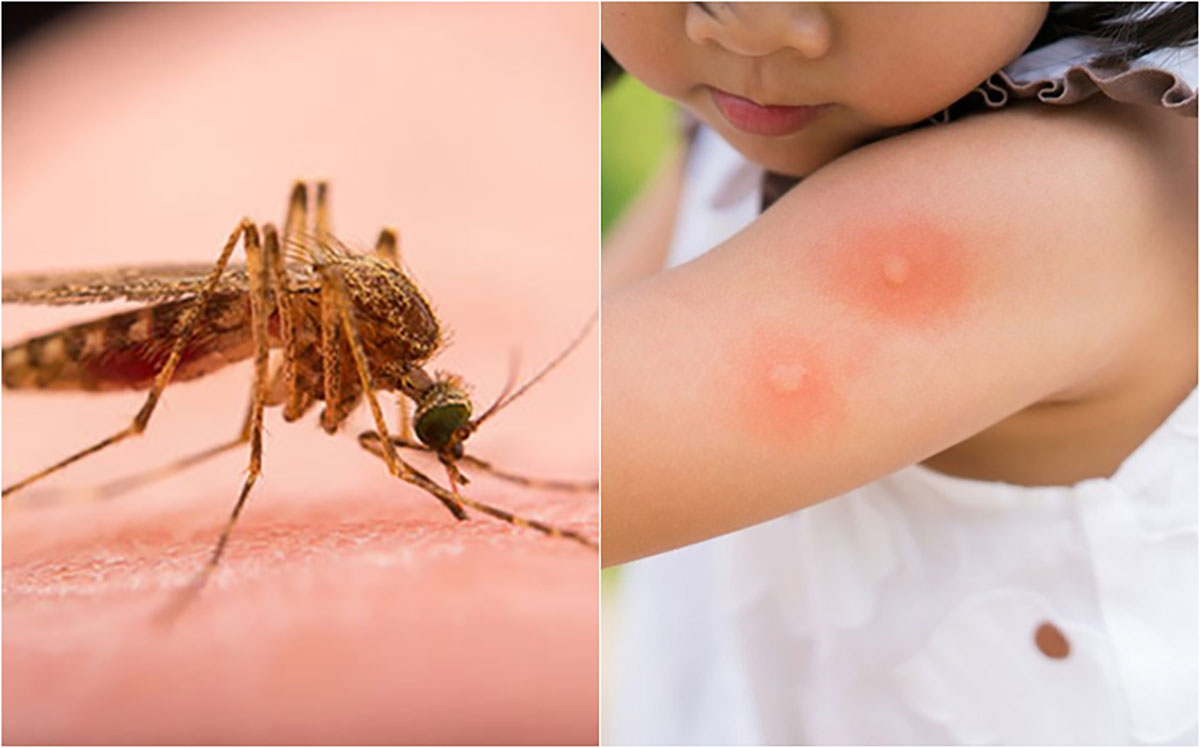 Trẻ bị côn trùng cắn nổi mụn nước có nguy hiểm hay không